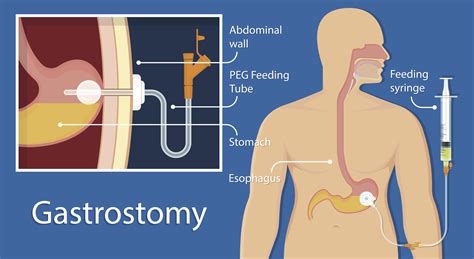 food insertion